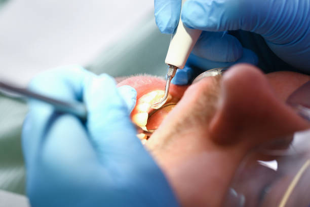 Best Emergency Dental Care for Abscessed Tooth in Concordia, MO